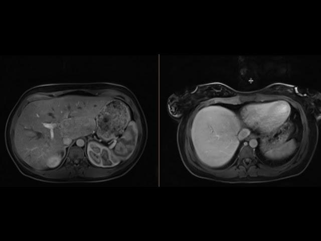 Hepatic Adenoma