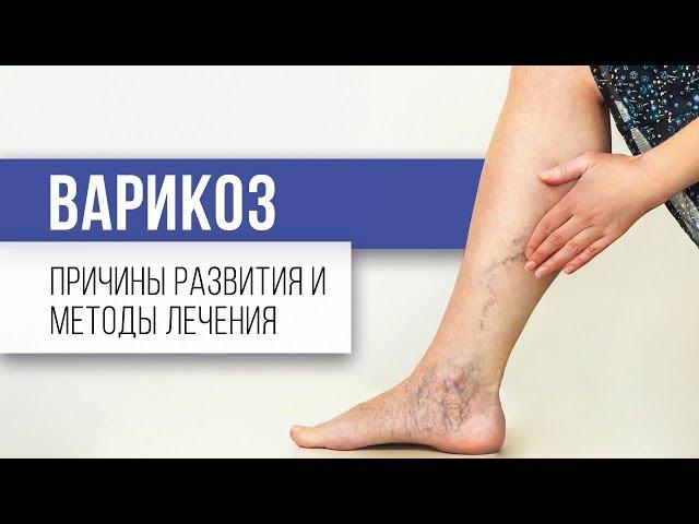 Что такое варикоз и как с ним бороться. Симптомы варикоза. Диагностика варикоза.