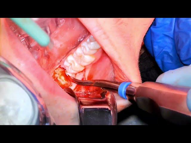 Lower Third Molar Impactions | Learn in 4K | OnlineExodontia.com