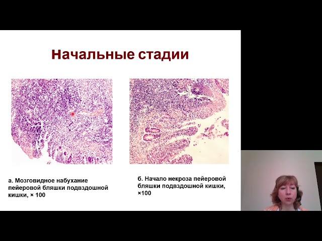 Патанатомия 16. Кишечные инфекции
