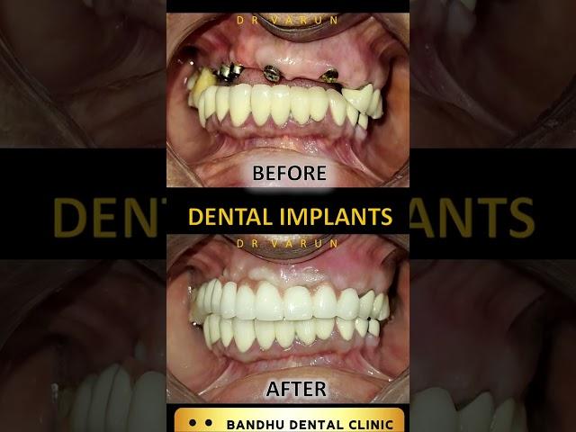 Best Dental Implants Delhi