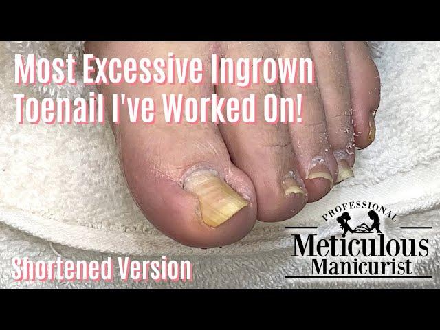 Most Extreme Ingrown Toenail Salon Pedicure - Shortened