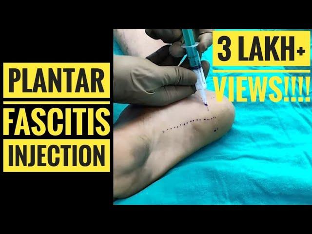 Plantar Fascitis Injection Technique