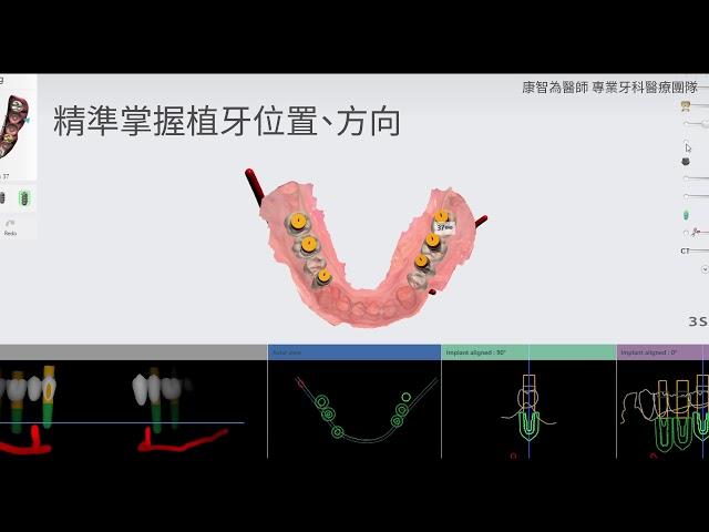 數位植牙｜為什麼有人植牙速度這麼快？多虧數位植牙讓手術變快了！