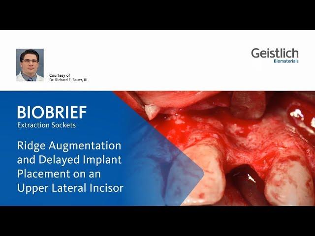 [Geistlich] Ridge Augmentation and Delayed Implant Placement by Dr. Bauer