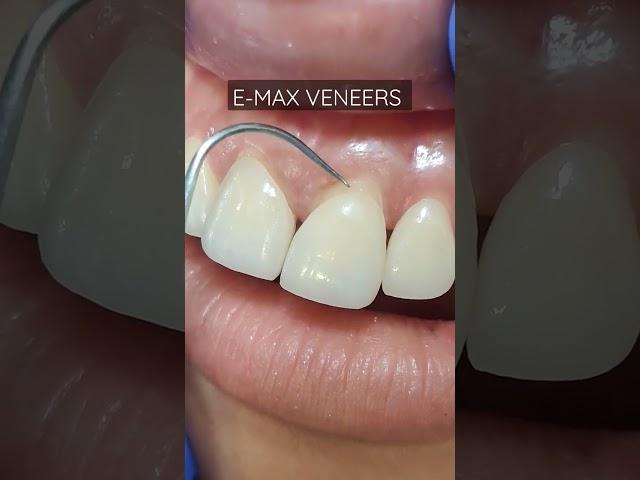 Get your smile corrected with E-Max veneers #veneers #porcelain #emaxveneers #dentalphotography