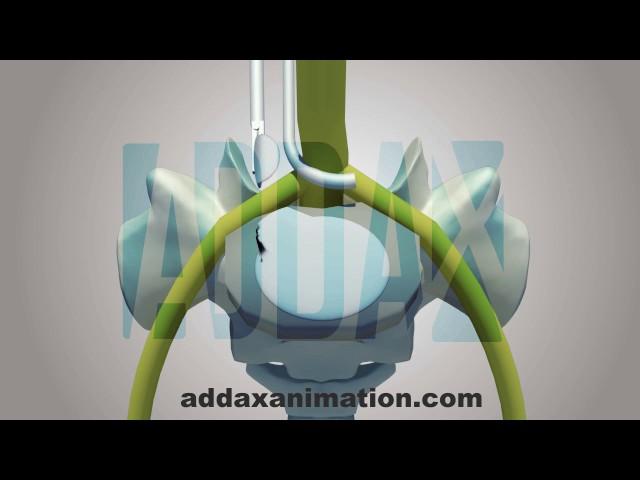 Lumbar Microdiscectomy surgery animation