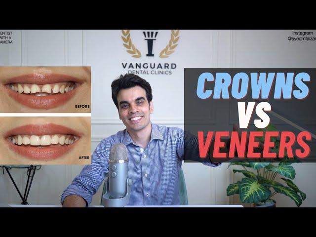 CROWNS VS VENEERS: WHICH ONE SHOULD YOU GO FOR?