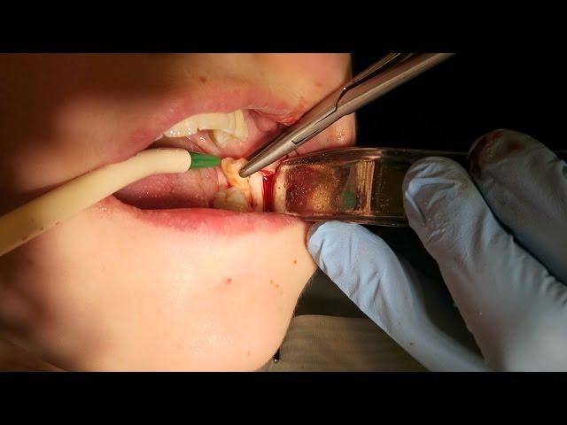 Surgical Extraction Of Wisdom Tooth l Dr. Abdul Dalghous | Yorkshire Dental Suite