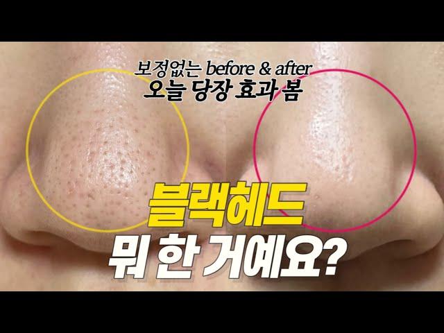 효과 20000% 진짜 확실하게 블랙헤드 없애는 방법 집에서 홈케어로!