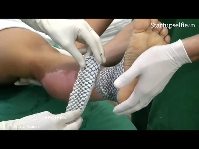 Brazilian doctors use fish skin to treat burn victims | Startup Selfie