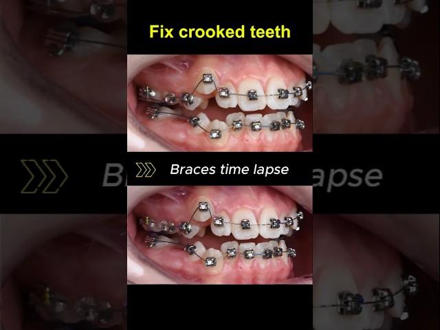 Braces for crooked teeth, transformation before and after #braces #orthodontist #dentist #bracket