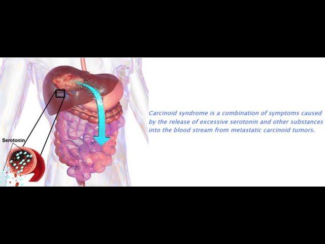 Carcinoid Syndrome