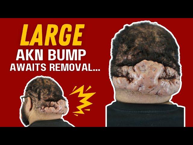 Large AKN Bump Awaits Removal by Dr. U