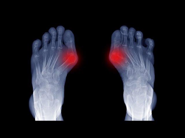 Hallux und Neurodermitis