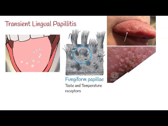 Transient lingual papillitis (Lie Bumps) - Inflammation of the tongue