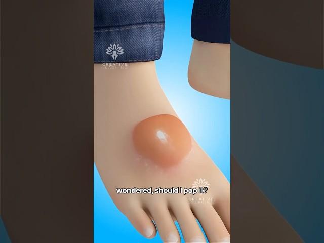 What Happens If You Pop a Blister  #short #viralvideo - Creativelearning3d