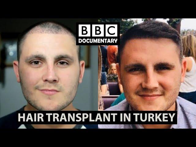 Hair Transplant Turkey - BBC Documentary | Paul Before & After