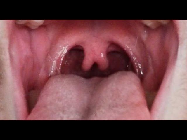Bifid Uvula - The Dos and Don'ts