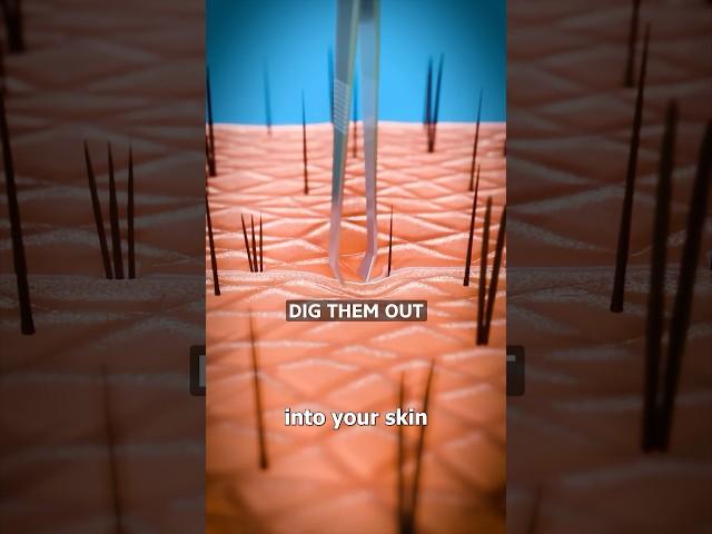 How Splinters Get Unstuck  Surgeon Reacts
