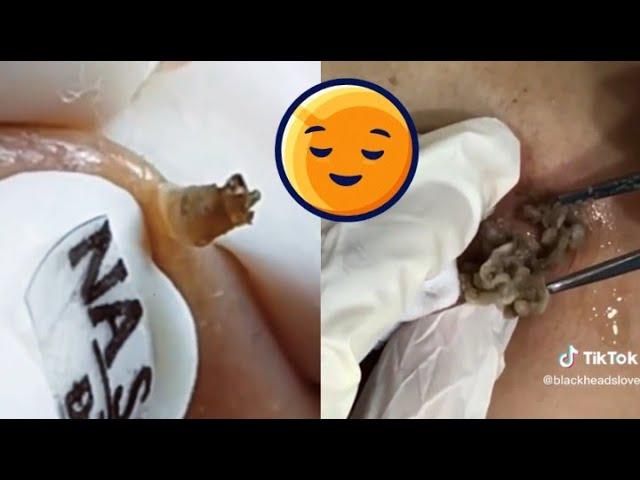 Top 10 Most Satisfying Acne Popping Moments Compilation - Blackheads, Cysts & More!