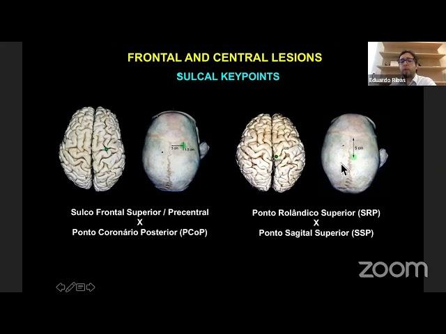 Frontal Lobe anatomy and Approaches to the Ventricles