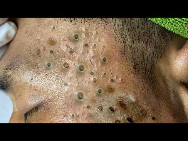 Blackheads Removal And Popping | Acne Treatment Bo Nguyễn 050