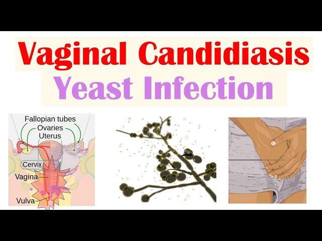 Vaginal Candidiasis (“Yeast Infection”) Causes, Risk Factors, Signs & Symptoms, Diagnosis, Treatment