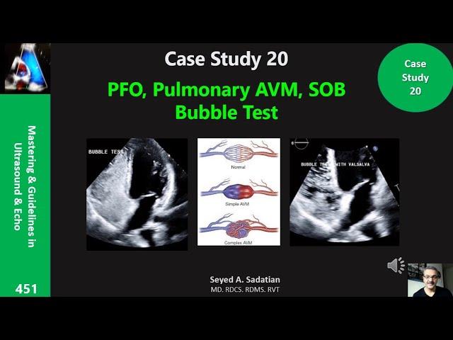 Case Study 20: PFO, Pulmonary AVM, SOB & Bubble Test