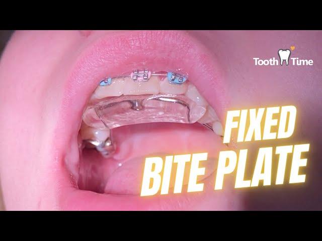 Deep Bite Braces - Fixed Bite Plate - ToothTime Family Dentistry