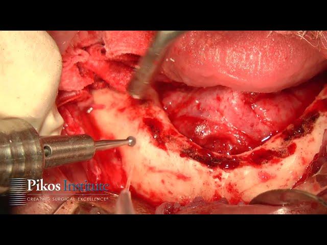 Easy Mandibular Anterior-Posterior Spread, Safely Avoiding Mental Nerve when Placing Dental Implants