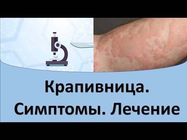 Крапивница. Причины. Симптомы. Лечение.