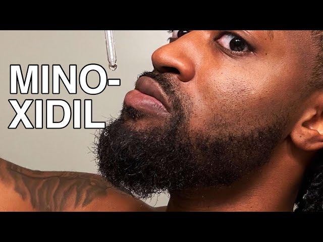 Why I Stopped Using Minoxidil | Does Minoxidil Actually Work?