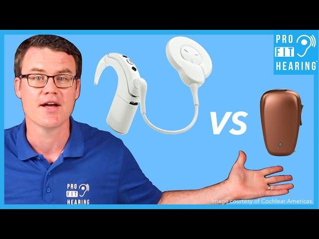 Cochlear Implant (CI) vs Bone Anchored Hearing Aid (BAHA)