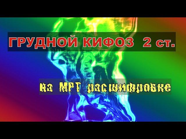 КИФОЗ ГРУДНОГО ОТДЕЛА позвоночника 2 степени на РАСШИФРОВКЕ МРТ грудного отдела