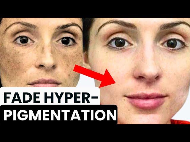 HOW TO GET RID OF HYPERPIGMENTATION, MELASMA, DARK SPOTS, SUN SPOTS, POST-INFLAMMATORY ERYTHEM