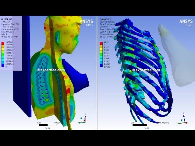 1st in the World!!! ANSYS WB Explicit Dynamics - Biomechanics simulation of leg kick in the chest