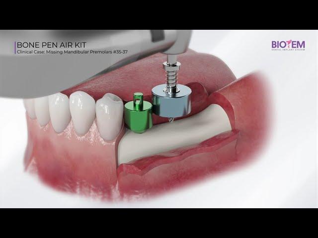 BIOTEM product - Bone Pen