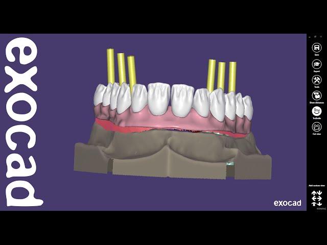 exocad Video Tutorial (advanced): Virtual Gingiva and Digital Waxup Design