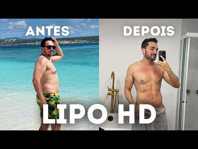 RESULTADO LIPO HD MASCULINA - Antes e depois da cirurgia de alta definição com Argoplasma e Morpheus