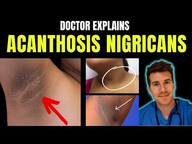 Doctor explains Acanthosis Nigricans - signs, symptoms, causes, treatment and more!