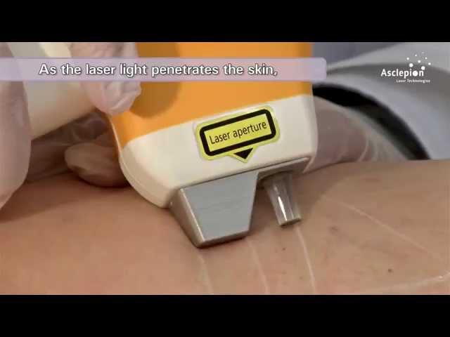 MeDioStar NeXT PRO - Training video for vascular treatment from Asclepion