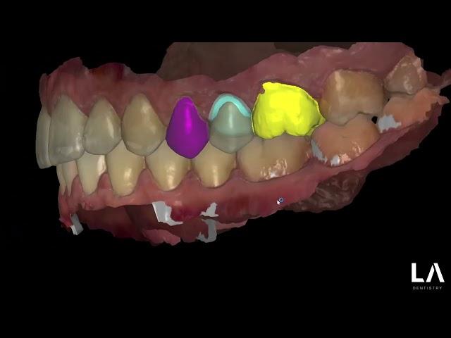 EGGSHELL TECHNIQUE Provisional Crowns in EXOCAD