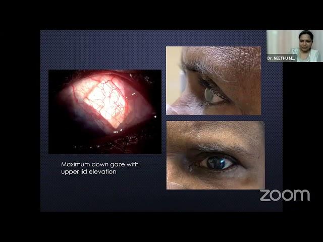 AIOS ARC Update Series on Challenging Moments in Glaucoma Surgeries   Dr  NEETHU MOHAN