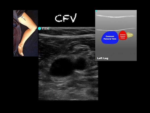 POCUS - Lower Extremity Deep Venous Thrombosis (DVT) - Updated