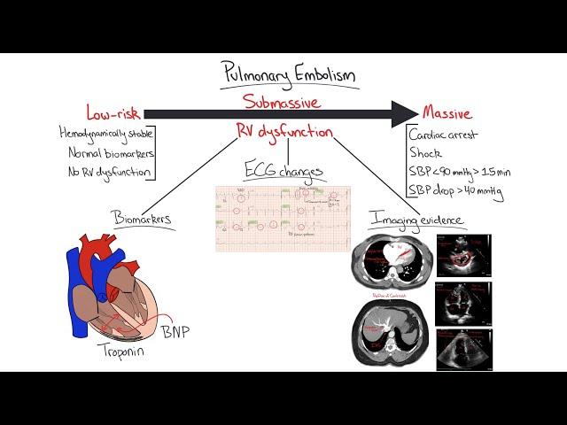 Chalk Talk: Pulmonary Embolism