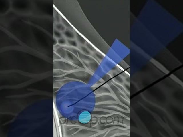 Breast Biopsy Wire Localization: Step-by-Step Guide   #PreOp #Shorts #BreastBiopsy Pt. 3