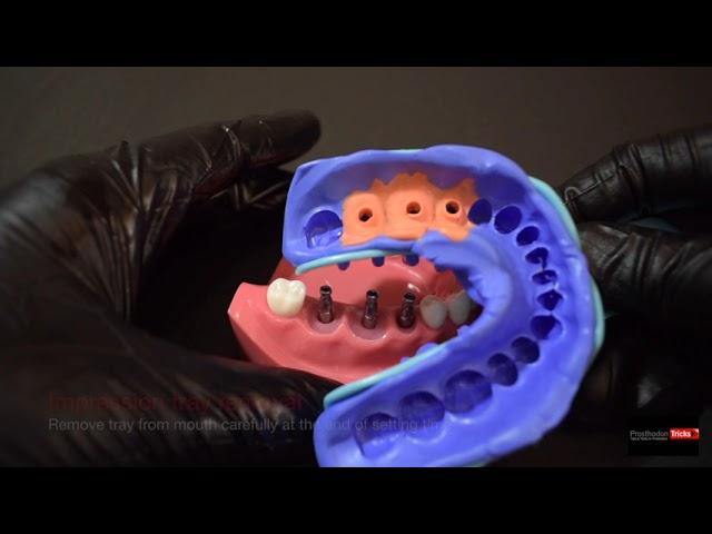 Impression Techniques for Implant Dentistry -  | step by step | Closed tray Impression technique