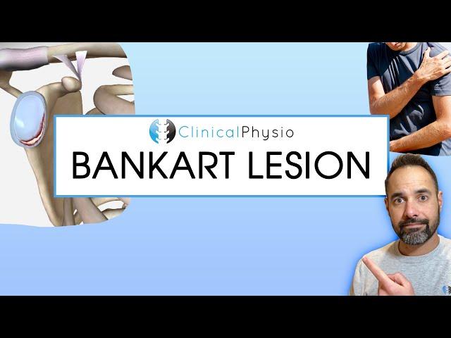 Bankart lesion | Expert Physio Reviews Shoulder Dislocations, Mechanism Of Injury and Treatment