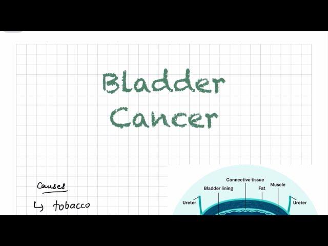 Bladder Cancer l UROLOGY l Surgery l Urologic Tumors
